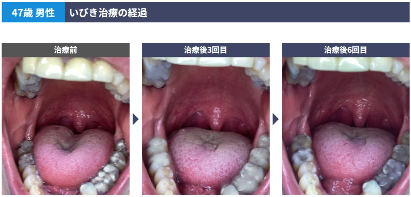 いびきメディカルクリニック　症例