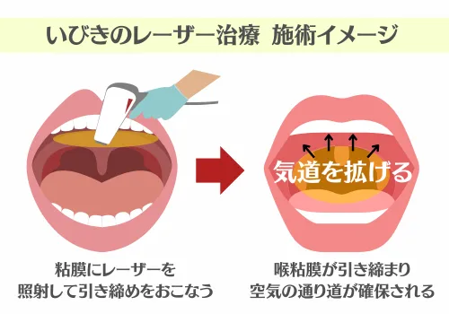 いびき　レーザー　治療