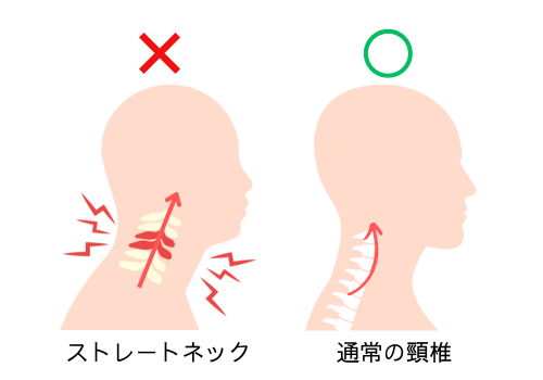 ストレートネック